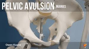 When to seek medical help. Pelvic Avulsion Injuries