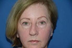 Eyelid Surgery Case 12