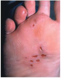 What to know if you get a rash during the pandemic and whether it could be related to coronavirus. A Collection Of Herpes Manifestations And Herpes Associated Syndromes Consultant360