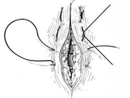 The horizontal mattress stitch is a suture technique used to close wounds. Suturing Techniques Gmd Group