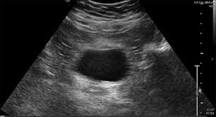 It allows ready (and portable) imaging of the . Pelvic Ultrasound Showing The Urinary Bladder Free Of Any Masses Download Scientific Diagram