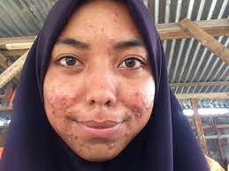 Tq bro.selepas seminggu guna produk ni jerawat dah hilang. Ubat Jerawat Dalacin T Yang Murah Dan Berkesan