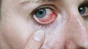 Hinter Roten Augen Kann Uveitis Stecken