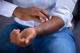 Now, imagine adding a few other unpleasant symptoms, such as painful inflammation and scaly patches, to the mix. Psoriasis Treatment Causes Symptoms