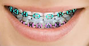 Use toothpick or dental floss. How To Relieve Pain Caused By Braces Theforbiz