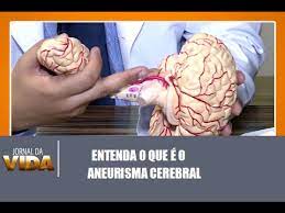 Quando isso acontece, a parte dilatada geralmente apresenta uma parede mais fina e, por isso existe um elevado risco de romper. Neuro Esclarece Sobre Aneurisma Cerebral Jornal Da Vida 15 02 2017 Youtube