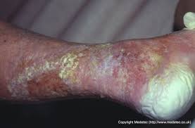 Image result for Skin Trauma