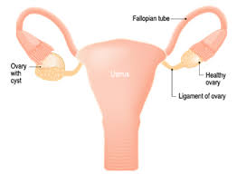 Although the symptoms of ovarian cancer may be vague, particularly in the early stages, they are usually fairly constant and represent a change from how you normally feel. Ovarian Cysts Types Symptoms Treatment In Akron Ohio
