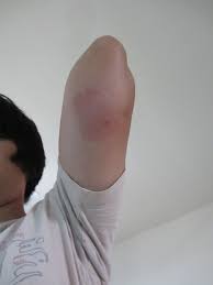 This reaction is not that common to everyone but the individuals having tendency to develop allergy are mainly affected with this type of syndrome. Pin On Skeeter Syndrome Pictures