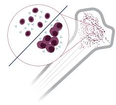 Image result for Multiple Myeloma