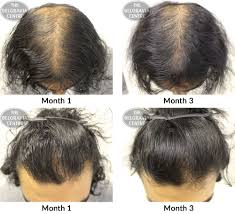 Often, it results in a few bald spots on the scalp, each about the size of a coin. Hair Growth Success The Staff Are Friendly And Are Always Willing To Help