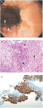 Labetoulle m, maillet s, efstathiou s, dezelee s, frau e, lafay f. A Case Of Herpes Esophagitis After Fluticasone Propionate For Eosinophilic Esophagitis Nature Reviews Gastroenterology Hepatology