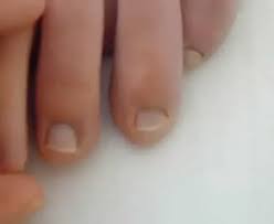 Image result for Capillary Refill