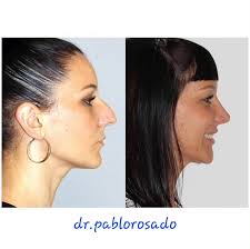 Hoy os traigo este precioso caso de blefaroplastia superior. Es  sorprendebte como un procedimiento tan poco invasivo contribuy a mejorar el  aspecto y la mirada.... ☺️ 🙏Muchas gracias a nuestra paciente por