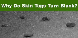 Patients often complain of painless, soft tissue felt on the outside of the anus. Why Do Skin Tags Turn Black Getting Rid Of Skin Tags