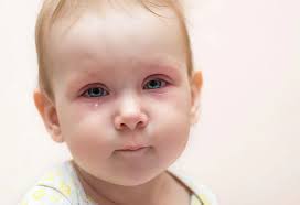 Skin rashes can be irritating, and not just because of the physical discomfort many cause. 10 Effective Home Remedies For Eye Infections In Babies