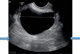 A simple ovarian cyst is one which is unilocular and fluid filled, with no septations, solid areas or other features. Sonographic Assessment Of Ovarian Cysts And Masses Chapter 8 Gynaecological Ultrasound Scanning