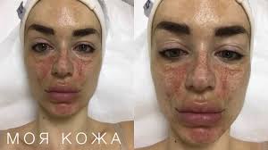 как убрать пигментные пятна на лице в домашних условиях отзывы Kak Ya Izbavilas Ot Pigmentacii Na Lice Procedury I Uhod Youtube