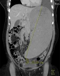 Image result for Splenomegaly