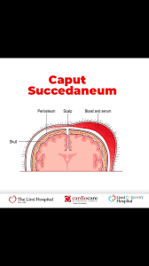 Image result for Vacuum Caput