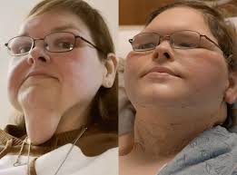 1000-Lb Sisters : Tammy Slaton Reveals Skin Removal Before and After