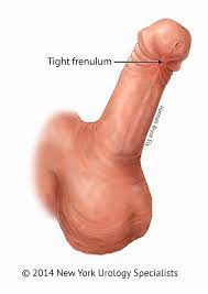 为治疗过短的包皮系带而进行的阴茎包皮系带矫正（包皮系带切开术） - Adult Circumcision in NYC