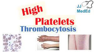 What Causes High Platelets (Thrombocytosis) | Approach To Causes, Symptoms,  Treatment - Youtube