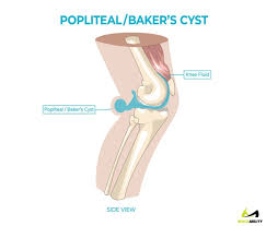 Penyebab sakit lutut dapat karena masalah dengan sendi lutut sendiri, atau penyebab lutut sakit tingkat keparahan sakit di lutut sangat bervariasi. Ketahui Penyebab Sering Merasa Nyeri Di Belakang Lutut