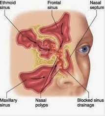 How To Prevent Nasal Polyps From Recurring Polyp Sinus Polyps How To Stay Healthy