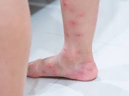 Ant Bites That Look Like Mosquito Bites 10 Bug Bites Anyone Should Be Able To Identify Bug Bites Remedies Bites And Stings Bug Bites