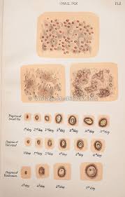 The Sick Rose Disease And The Art Of Medical Illustration Pdf Vintagemedstock Smallpox Medical Photos Vintage Medical Medical Illustration