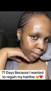 Transforming My Hairline in 71 Days Journey