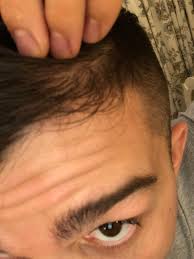 Is The Left Front Side Of My Hair Thinning Hairlosstalk Forums