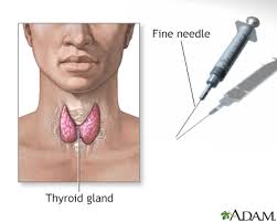 American thyroid association taskforce on radioiodine safety. Thyroid Nodule Information Mount Sinai New York