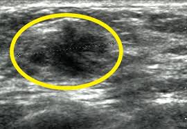 Can ultrasound detect breast cancer? Breast Cancer Echocardiography Or Ultrasound Wikidoc
