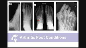 Other conditions, like osteoporosis or arthritis, may also cause bone or joint pain. Common Bone Problems In Feet Country Foot Care Podiatry Long Island