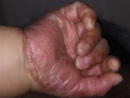 Hand, foot, and mouth, also called coxsackie virus, is an infection caused by the enterovirus. Hand Foot And Mouth Disease Dermnet Nz