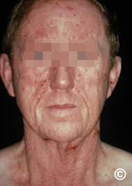 Image result for Photodermatitis
