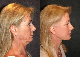 Maybe you would like to learn more about one of these? Sculpting The Jawline A Youthful Jawline Makes For A Youthful Face New York Social Diary