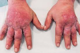 Image result for dermatitis contacta