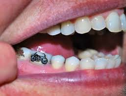 Maybe you would like to learn more about one of these? Tattoo Dental Blog With Dr Anto Youssef