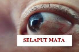 Karena pemberian obat ini adalah salah satu cara termudah dan paling umum untuk menghilangkan selaput di mata kucing di antara pemilik kucing. Tips Merawat Masalah Rabun Dan Selaput Mata Posts Facebook