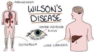 Understanding Wilson S Disease Youtube