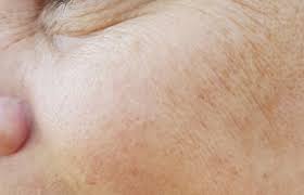 I have developed a lot of dents and uneven bumpy skin on my face, specially around my cheek area. Uneven Skin Tone Texture Biobalance Skin