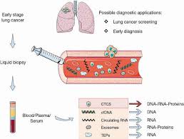 Less common symptoms of lung cancer include: Liquid Biopsy For Lung Cancer Early Detection Santarpia Journal Of Thoracic Disease