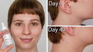 This alpha arbutin is easy to use, more of a gel like consistency, little sticky but only for a few seconds, it dries fast and well. The Ordinary Alpha Arbutin 2 Ha Before After With Pictures Hyperpigmentation Dark Spots Youtube