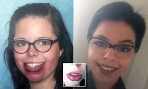 Tasmanian woman Tamara Bennett whose lips will never stop growing due to  rare condition