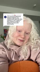 Understanding Nystagmus and Albinism: Why Do Eyes Shake?