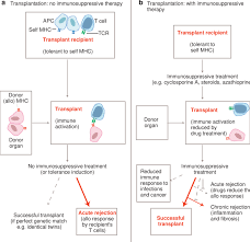 Image result for Transplant Rejection