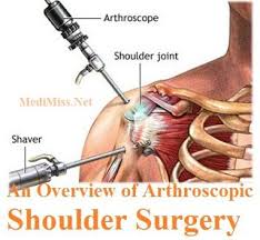 Shoulder Arthritis Surgery Is An Insignificantly Obtrusive Orthopedic Surgical Arthroscopic Shoulder Surgery Shoulder Arthritis Shoulder Surgery
